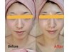 ◎美肌贅沢艶肌set《IPL光フォトFlash/RFリフトアップ/ピーリング》