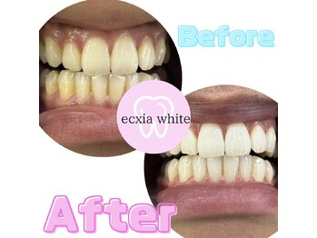 エクシアホワイト 新宿御苑店(ecxia white)/ホワイトニングビフォーアフター
