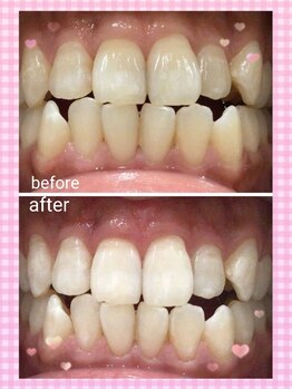 カシワビューティーココ(kashiwa beauty coco)/セルフホワイトニング