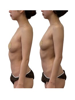 ベンザイ 梅田店(BENZAI)/バストが硬い、デコルテの削げ