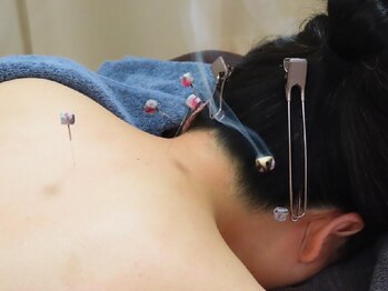 イスクラ中医鍼灸院の写真/【首肩こり眼精疲労】デスクワーク疲れの蓄積に～７０分８８００円！