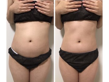 リズビー(Lisbe)/薬院/リンパ/痩身