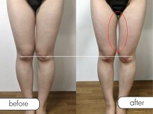 エステルーム ココ(COCO)/痩身/キャビテーション施術後