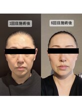 ザ フェース 淀屋橋店(THE FAITH)/光糸リフト6回の変化