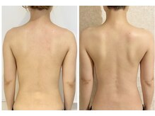 ザ エステティック福岡/長年のファンの多い背中コルギ