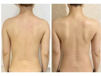 ザ エステティック福岡/長年のファンの多い背中コルギ