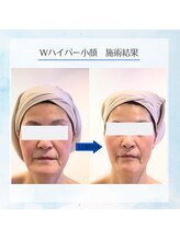 ルミナ ビューティーアンドリラックス(LUMINA Beauty&Relax)/小顔&たるみ改善にはこれ☆