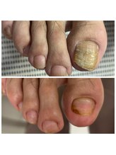 ドクターネイル爪革命 十条店/肥厚爪ケア