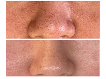 ベル(Bell)/毛穴洗浄フェイシャル/毛穴/脱毛