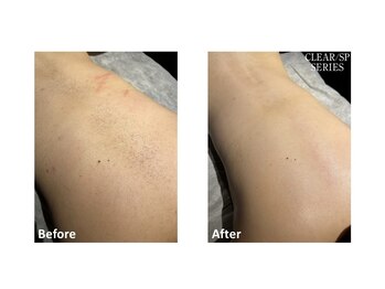 ロカビリー(Rockabilly)/メンズ　背中脱毛