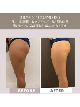 コンバートビューティーオタイ(ConBert Beauty otai)/ヒップアップ&セル脂肪分解