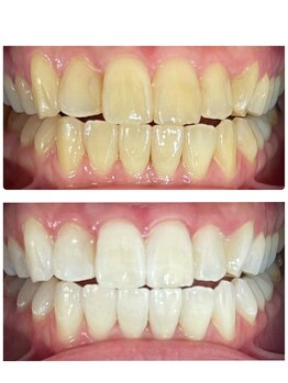 エクシアホワイトニング 札幌中島公園店/Before After［ホワイトニング］