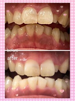 カシワビューティーココ(kashiwa beauty coco)/セルフホワイトニング