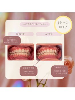 プラスビーセルフ(+b self)/ホワイトニングビフォーアフター