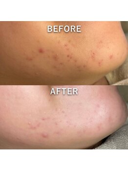 マーブルスタイル(MARBLE STYLE)/【BeforeAfter】 1回目/5回目