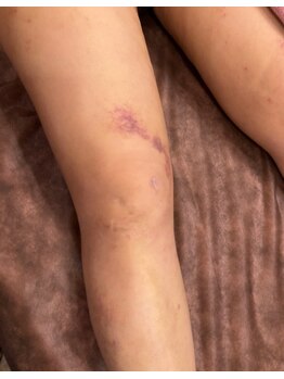 エステアンドヘアーサロン アルテ 札幌/足がパンパンで固い術後