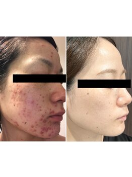 ザ フェース 淀屋橋店(THE FAITH)/光糸リフト12回の変化