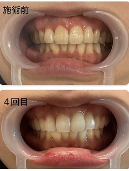 ホワイトニング専門店 スマイルホワイト/20代女性