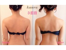 カウラ(Kaura)/背中ビフォーアフター(肥後橋)