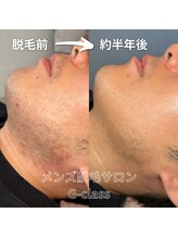 ノビシロホワイトニング(nobi-SHIROホワイトニング)/ヒゲ光脱毛