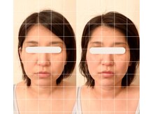 グロッシー(glossy)/小顔矯正