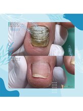 巻き爪補正店 秋葉原店/ 【分厚い爪/変形爪再生補正】