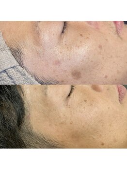 メンズフェイシャル