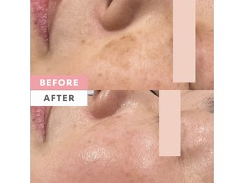 ハリーネ(HARINE)/【4回で効果実感】