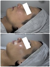 ナチュールムーン(Nature moon.)/男性　ハーブピーリング