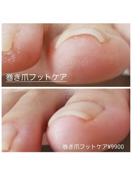 ピピ(PiPi)/【巻き爪フットケア】