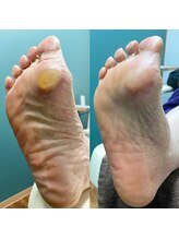 足のトラブルセンター 狸小路店/角質除去