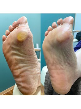 足のトラブルセンター 狸小路店/角質除去