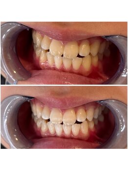 エクシアホワイトニング 代々木店/ビフォーアフター　代々木/新宿