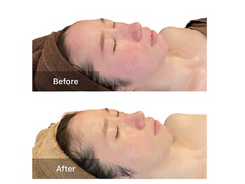 ベンザイ 梅田店(BENZAI)/乾燥、赤み、毛穴の悩みにも!