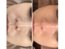 長年のしみ・肌荒れ・毛穴のたるみ・元気のないお肌改善に！