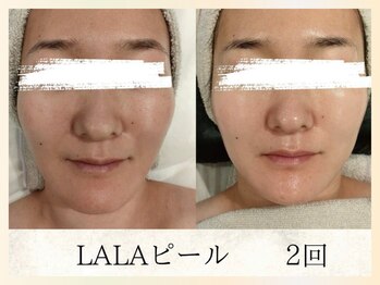 ソウナ(SONA)/韓国肌育ピーリング ララピール