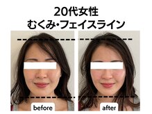 シン(SHINE)/美容鍼灸