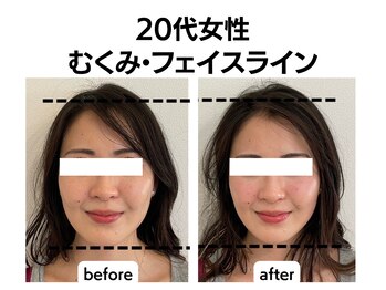 シン(SHINE)/美容鍼灸