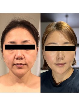 ザ フェース 淀屋橋店(THE FAITH)/光糸リフト13回の変化