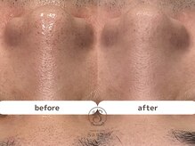 サンゴ(Sango)/毛穴黒ずみ/開き/ざらつき改善