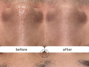 サンゴ(Sango)/毛穴黒ずみ/開き/ざらつき改善