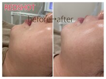 ペルボヌール 深井店/REDSHOT1回(施術直後)