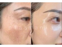 エフェクト 塚口店(effect)/Before After