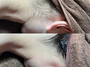 ゴールデンエイジ 吉祥寺(GOLDEN AGE)/ワックス脱毛:施術