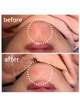 ねね整骨院 エヌシャープ(N#)/気になるニキビにアプローチ！