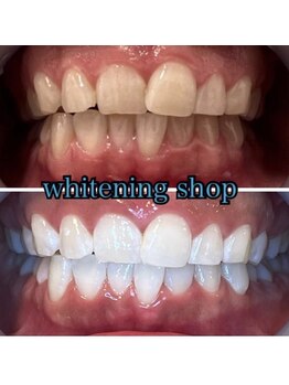 ホワイトニングショップ 高松瓦町店/Before&After美白ホワイトニング