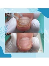 巻き爪補正店 秋葉原店/ 【分厚い爪/変形爪再生補正】