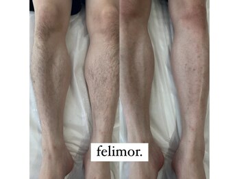 フェリモール(Felimor.)/シュガーリングbefore／after