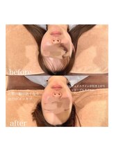 ライム 松本(LIME)/《Hi-UP＊注射しないエラボト》