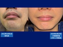 父さん専用ヒゲ脱毛の店/脱毛比較写真　＃ヒゲ脱毛＃脱毛